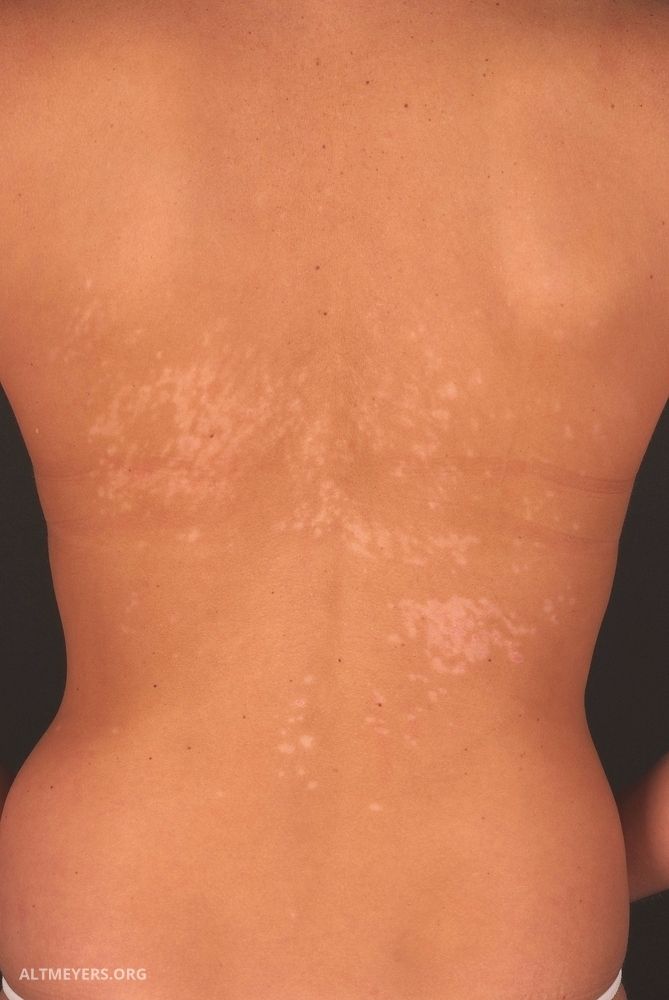 Pityriasis Versicolor Ubersicht Altmeyers Enzyklopadie Fachbereich Dermatologie