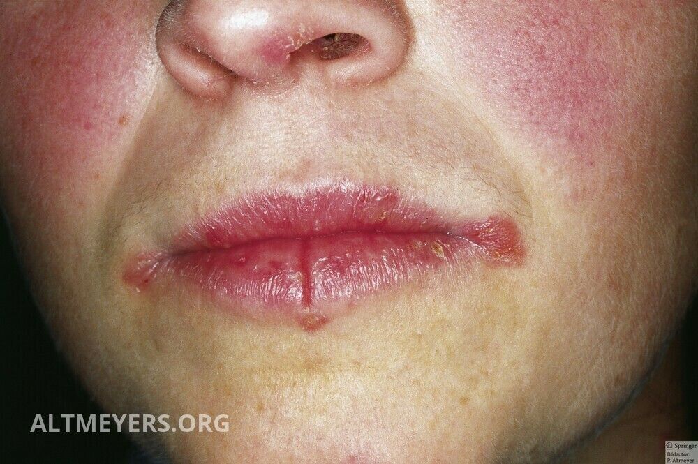 Perleche Ubersicht Altmeyers Enzyklopadie Fachbereich Dermatologie