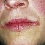 Perlèche (overview) - Altmeyers Encyclopedia - Department Dermatology