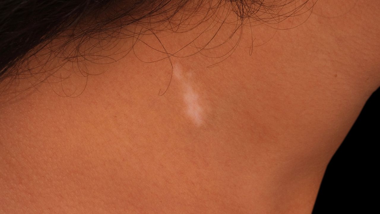 Piebaldismus Altmeyers Enzyklopadie Fachbereich Dermatologie