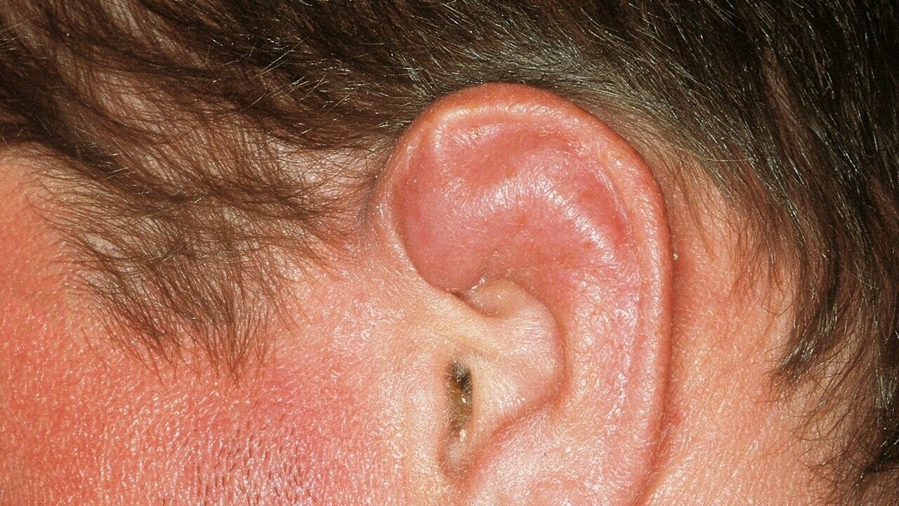 Lump on Ear: What To Do | ENT Specialist Singapore