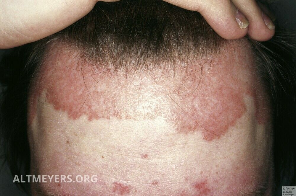 Psoriasis Capitis Altmeyers Enzyklopadie Fachbereich Dermatologie