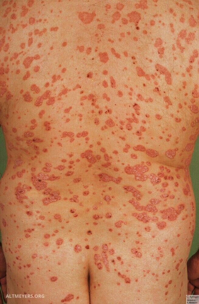 gyakori psoriasis vulgaris kezels