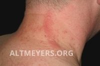 Raupendermatitis - Altmeyers Enzyklopdie - Fachbereich Allergologie