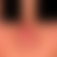 Circumscribed rhinophyma: localized phymogenesis of the nose in moderately severe rosacea. Chroni...