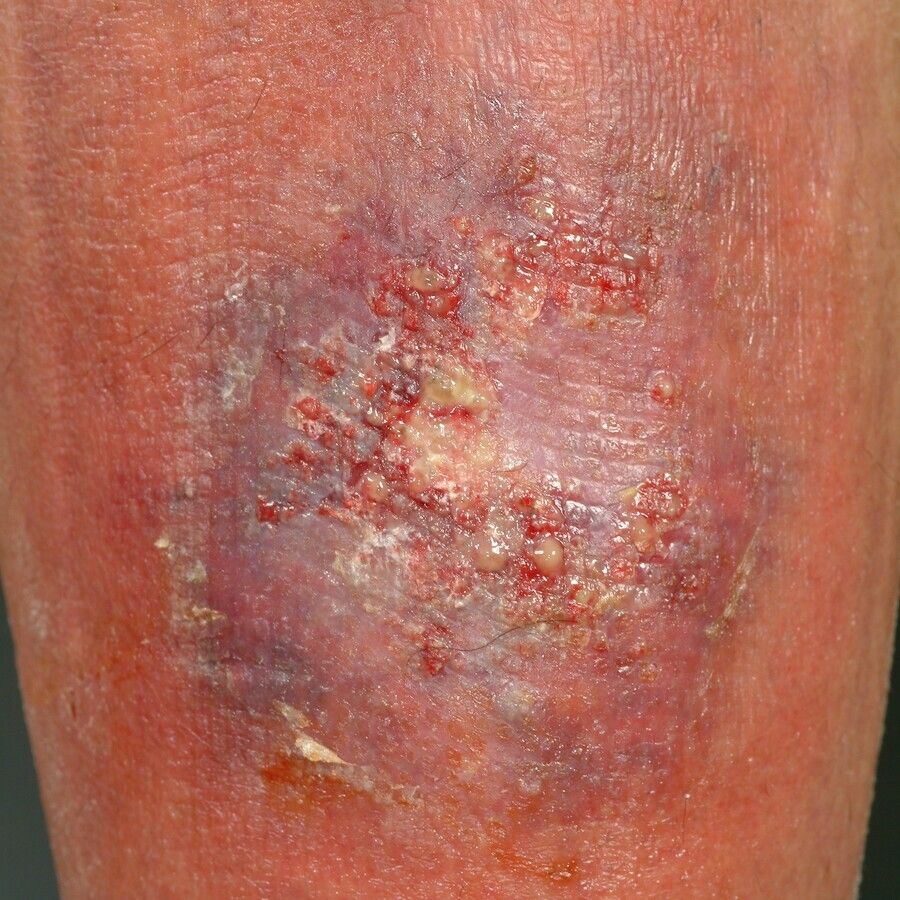 Pyoderma Vegetans And Vasculitis