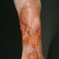 Pyoderma gangraenosum Images - Altmeyers Encyclopedia - Department ...