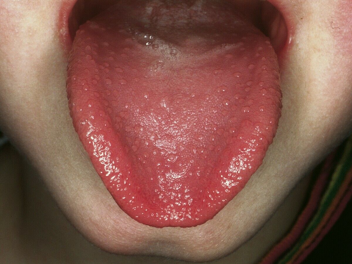 Scarlet Fever - American Osteopathic College of Dermatology (AOCD)