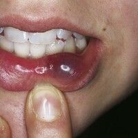 Traumatische Schleimzyste Images - Altmeyers Encyclopedia - Department Dermatology