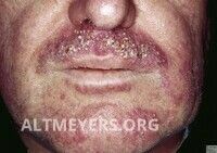 Tinea barbae (dermatomycosis barbae, schimmelinfectie van de