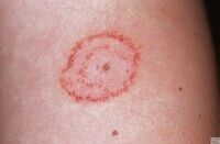 Renaissance Dermatology Specialist Clinic - Tinea corporis is a superficial  fungal infection of the skin that affects the body and limbs. It is  commonly called 'ringworm' as it presents with characteristic ring-shaped