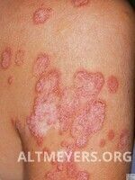 Tinea barbae - Altmeyers Encyclopedia - Department Dermatology