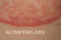 Superficial tinea capitis - Altmeyers Encyclopedia - Department Dermatology