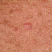 Syphilide papular Images - Altmeyers Encyclopedia - Department Dermatology