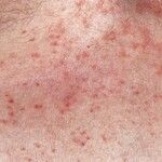 Transitorische akantholytische Dermatose - Altmeyers Enzyklopädie ...