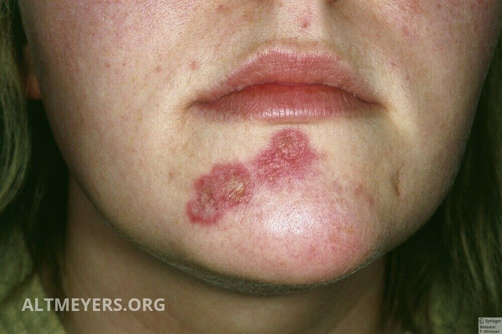 chronic cutaneous lupus erythematosus