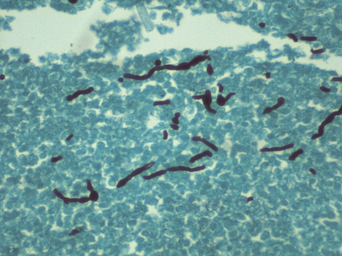Tinea Nigra (tinea nigra palmaris, tinea nigra plantaris, pityriasis nigra,  keratomycosis nigricans palmaris) - Dermatology Advisor
