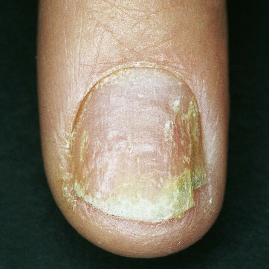 VW Dermatology - Onychomycosis, also known as tinea unguium, is a fungal  infection of the nail. Symptoms may include white or yellow nail  discoloration, thickening of the nail, and separation of the