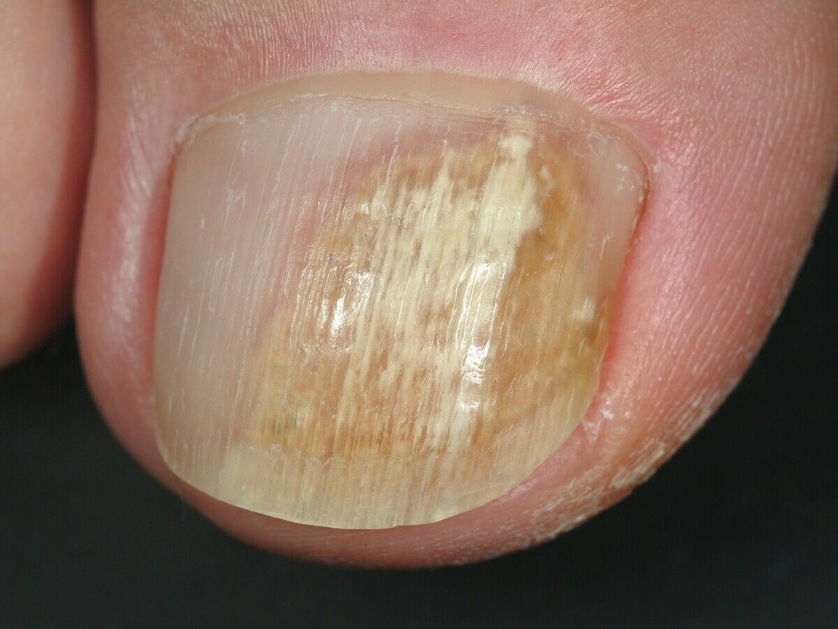 File:Onychomycosis (tinea unguium).jpg - Wikimedia Commons