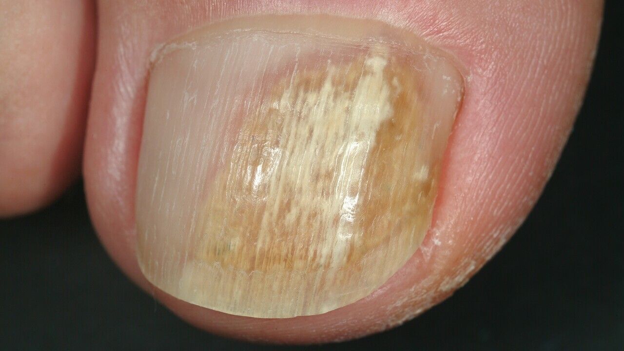 Paronychia - MedEd Cases, image size:1280x720