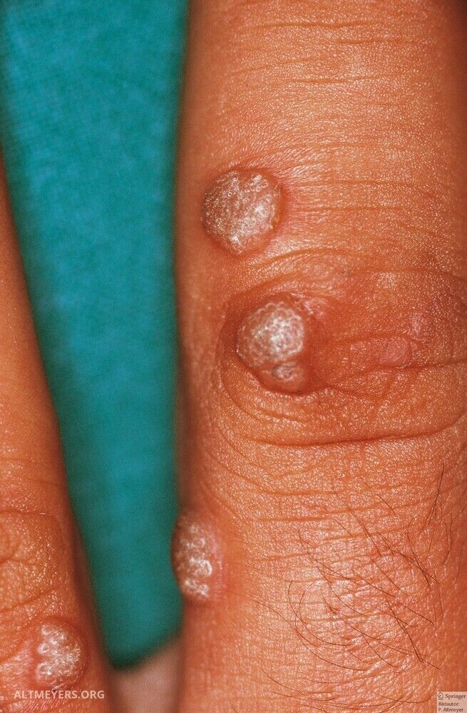 Verruca Vulgaris Altmeyers Encyclopedia Department Dermatology Verruca Vulgaris Altmeyers Encyclopedia Department Dermatology