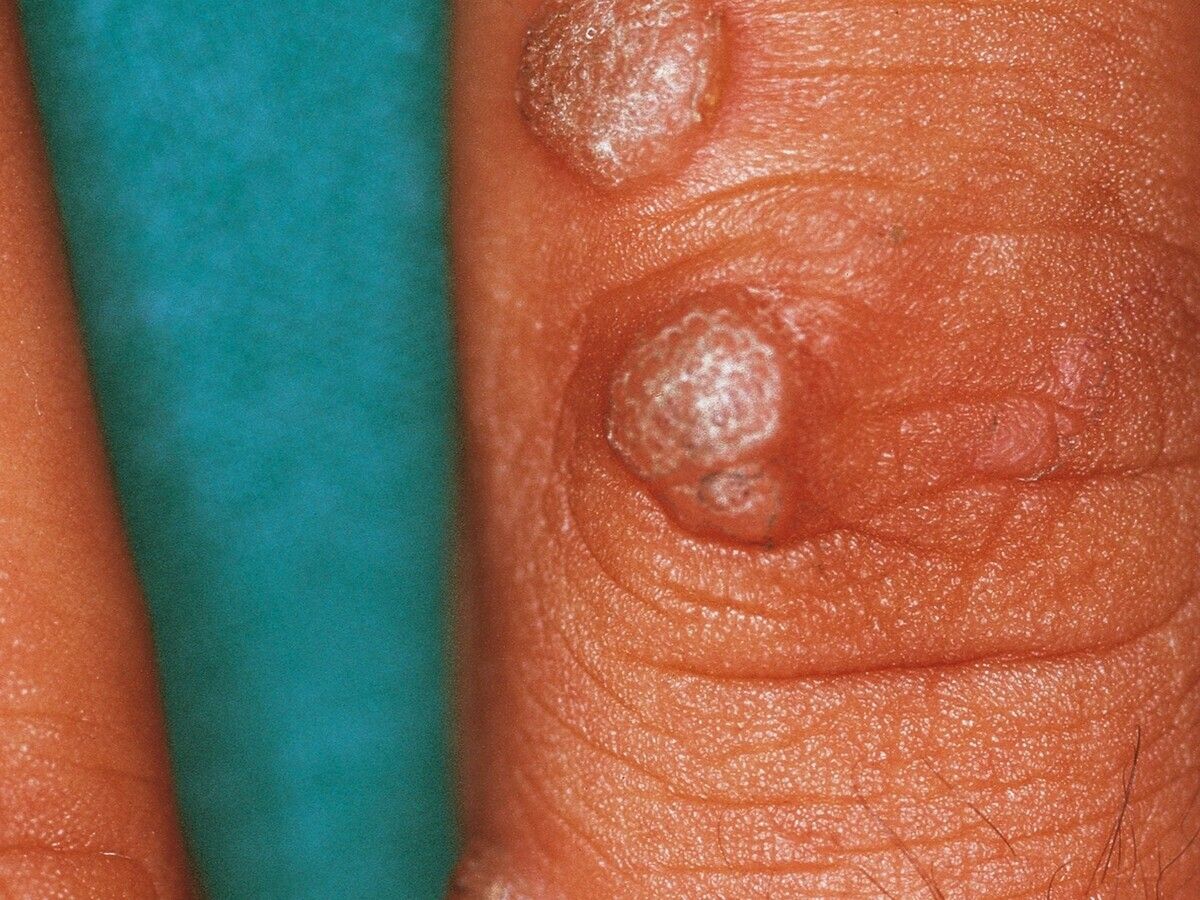 Verruca Vulgaris Altmeyers Encyclopedia Department Dermatology Verruca Vulgaris Altmeyers Encyclopedia Department Dermatology