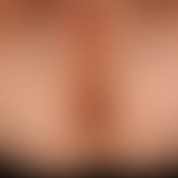 Vitiligo: large symmetrical area of the genito-anal and buttock region, central strip in the geni...