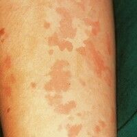 Urticaria (overview) Images - Altmeyers Encyclopedia - Department 