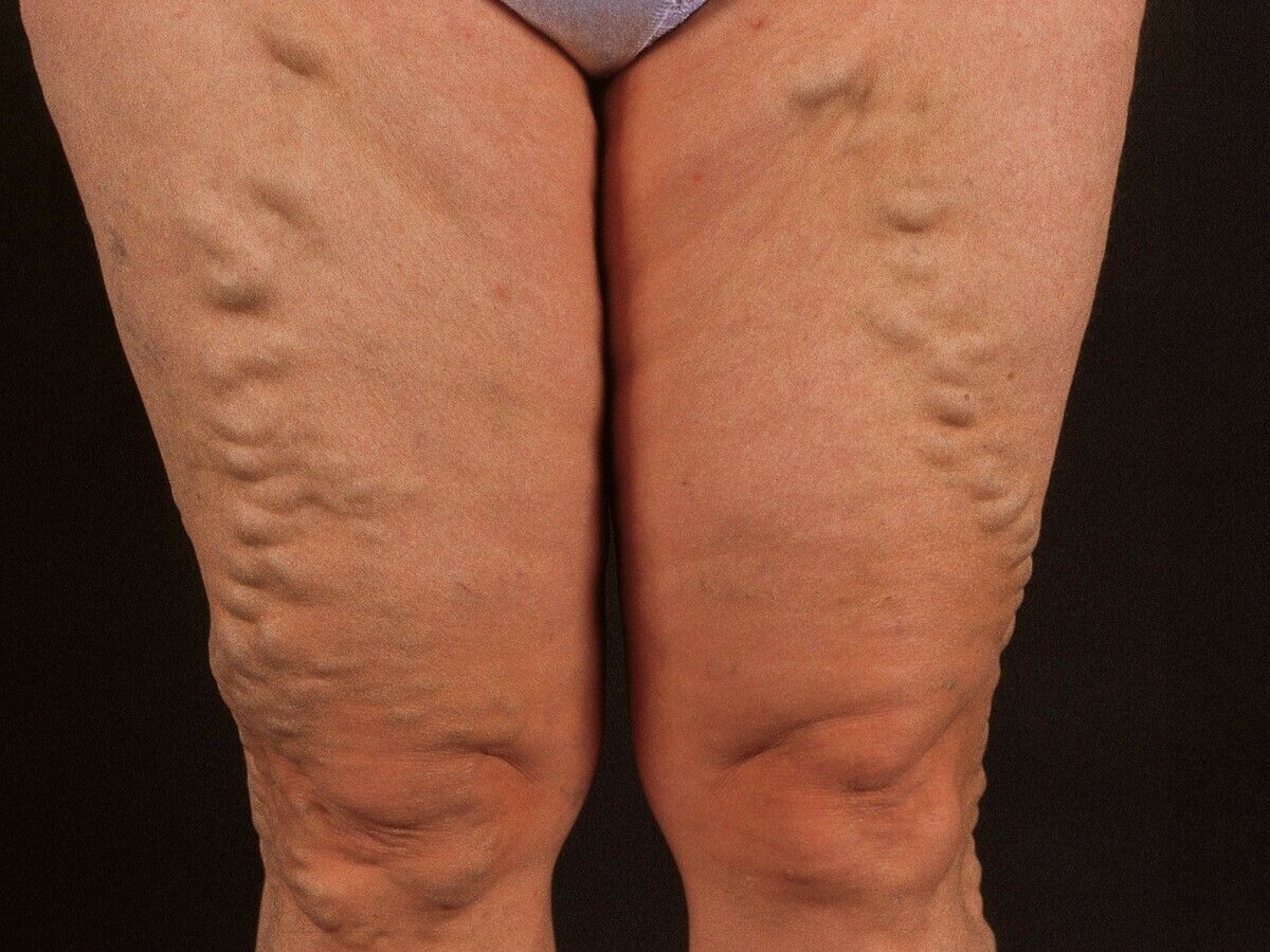 Do Compression Stockings Help Stop Varicose Veins?: Goldman Vein