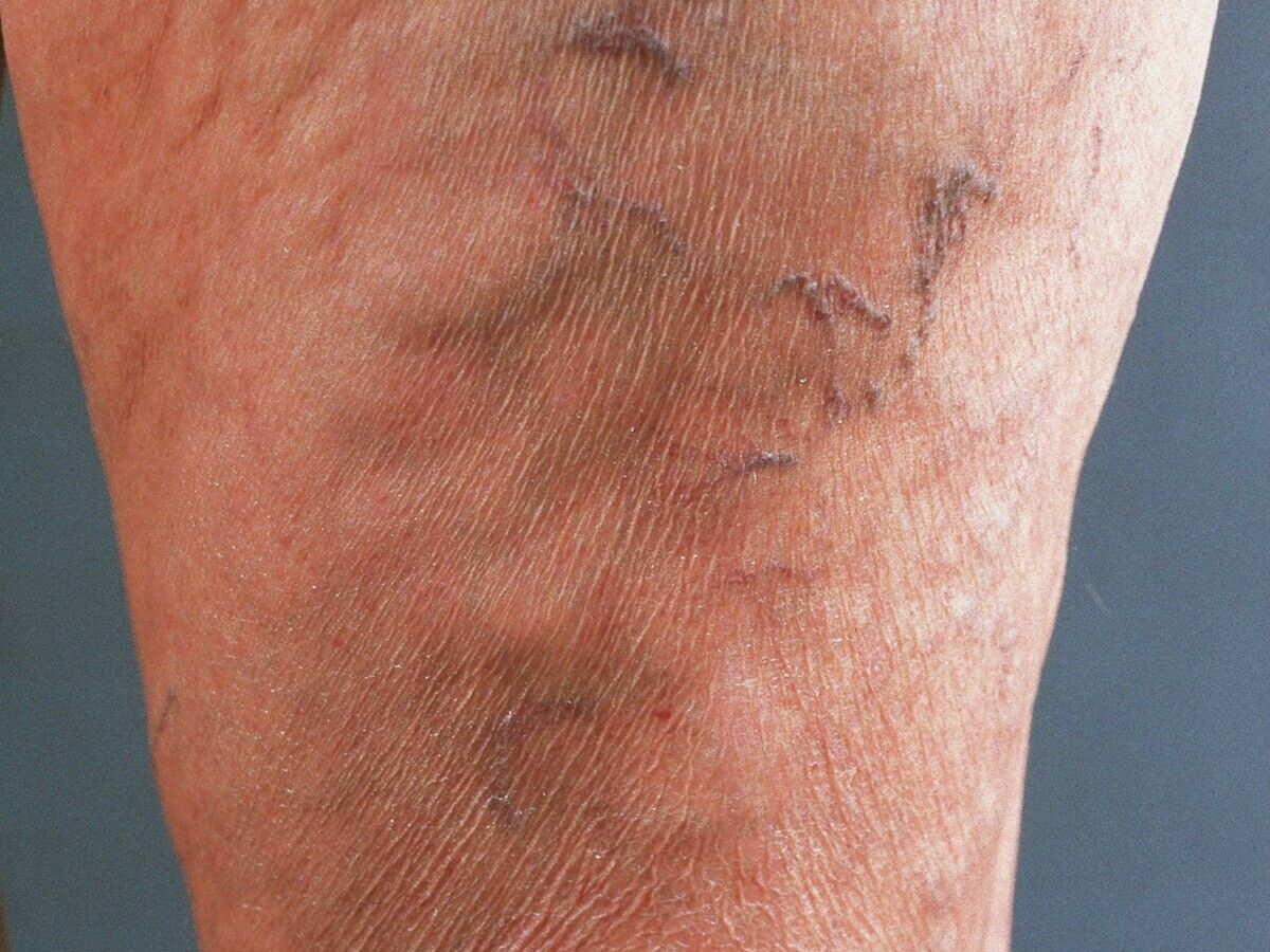 Picior cu bandă Kinesio - Prevenirea January