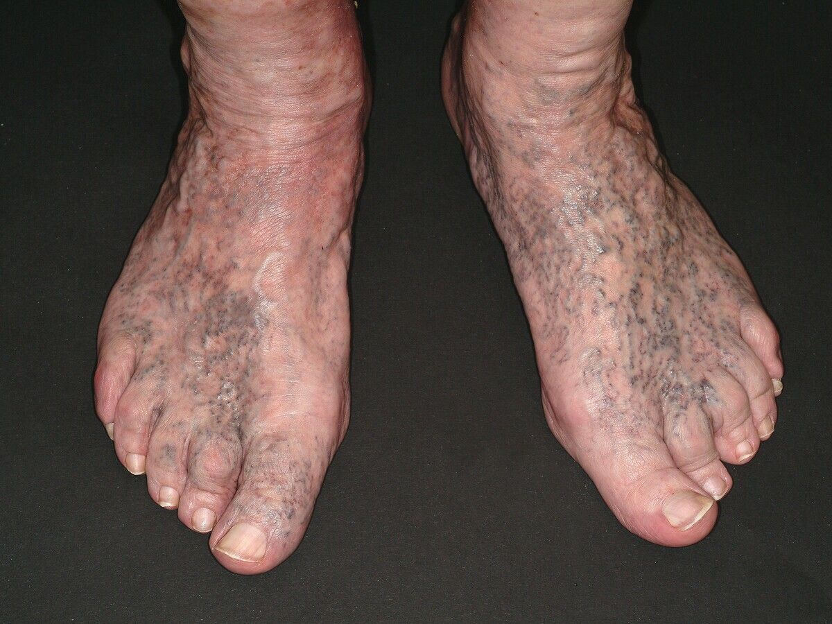 varicoza edema foot)