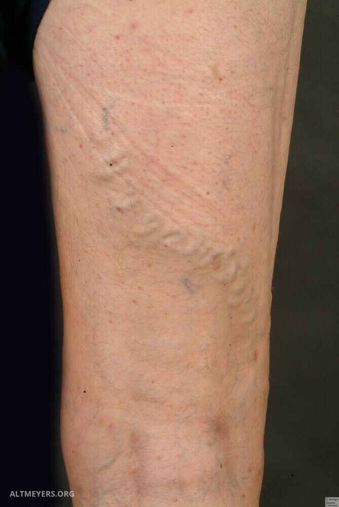 recular intradermic varicoza am 14 varicoza