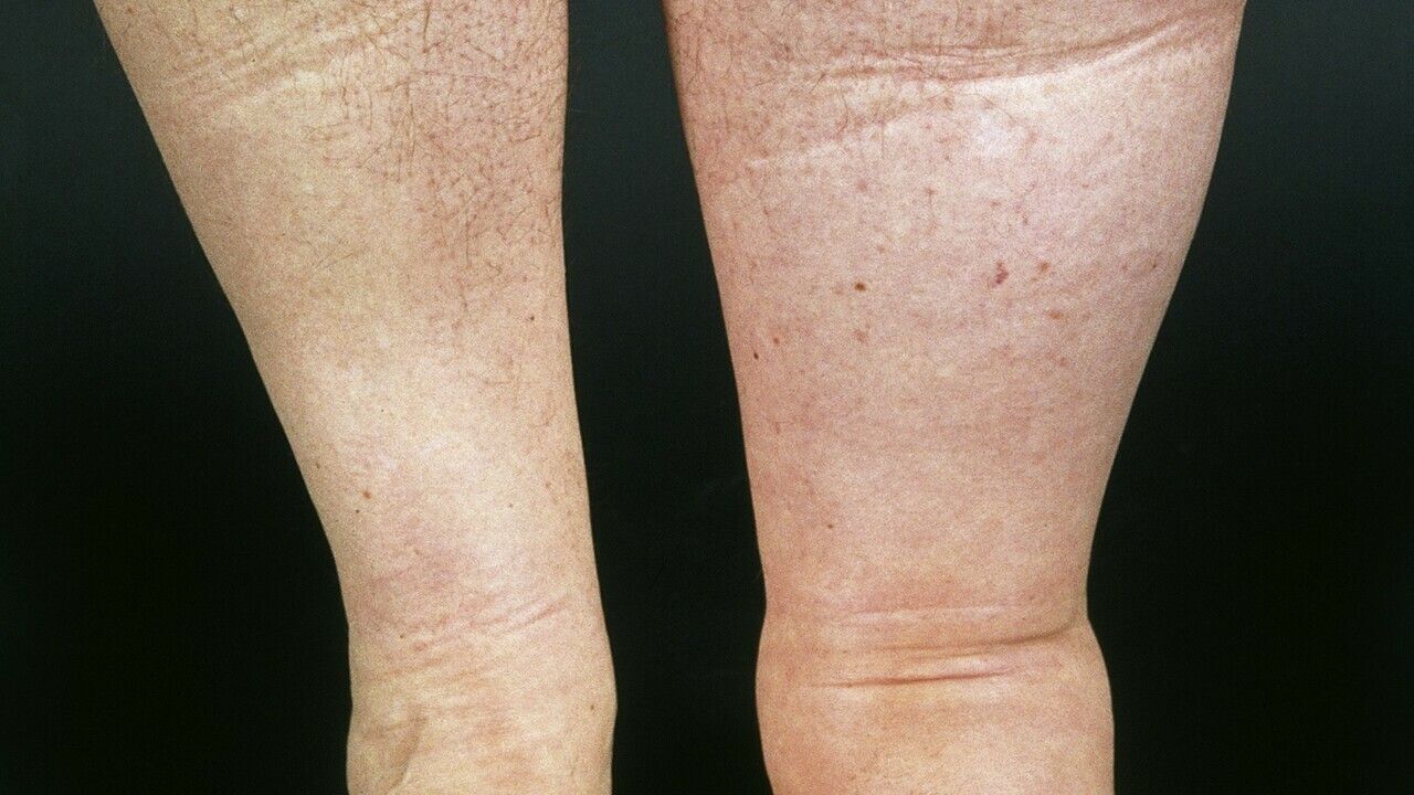 picioarele pot pierde din varicoza unguent de la picior de varicoza