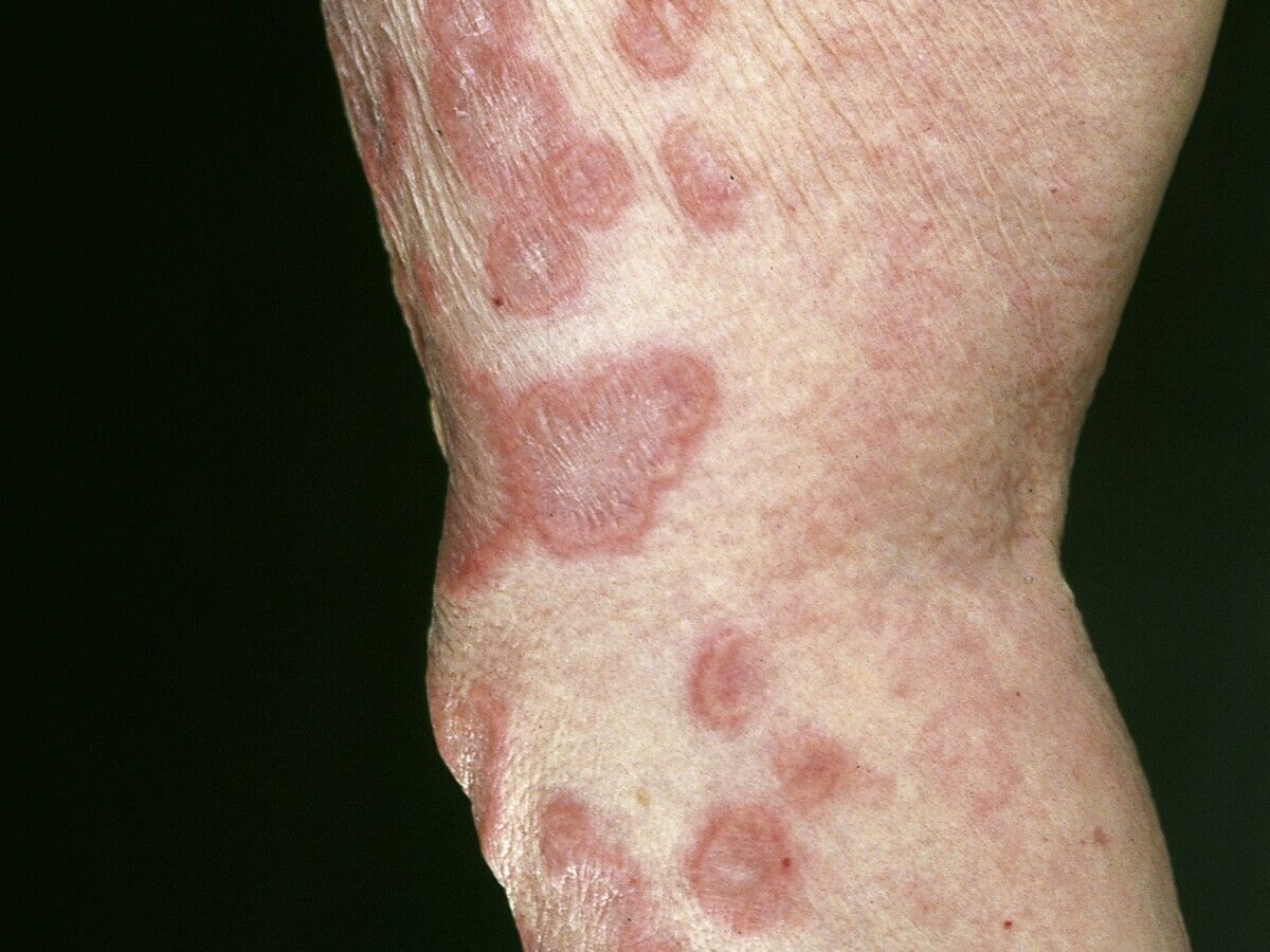 wallpapers Mycosis Fungoides Tumor Stage Pictures cutaneous t cell lymphomas overview