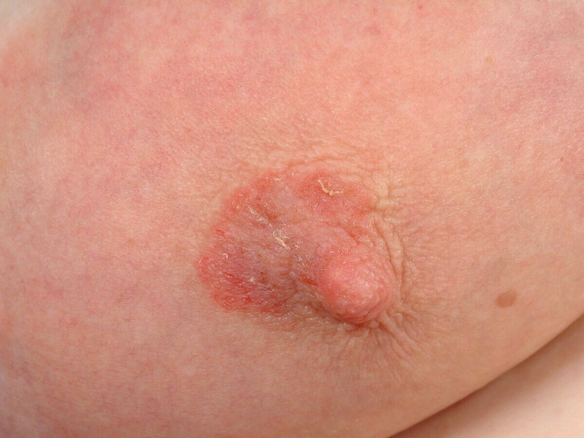 Breast dermatitis - Altmeyers Encyclopedia - Department Dermatology