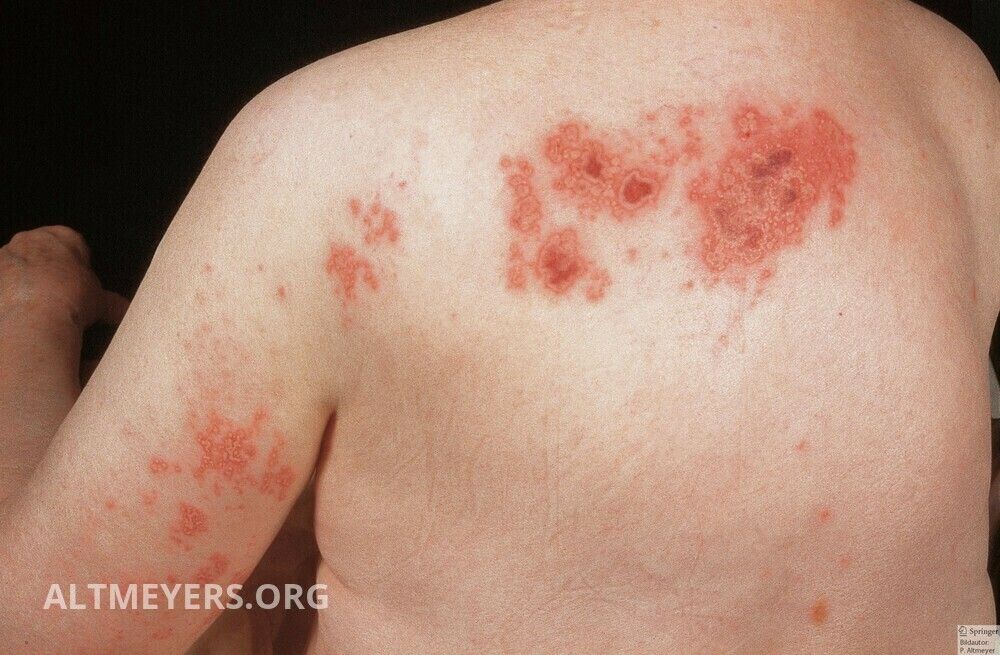 Herald Zozhe prosztatitis kezelés Homeopátiás orvoslás a prosztatitishez