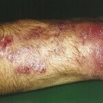 Candida granuloma - Altmeyers Encyclopedia - Department Dermatology