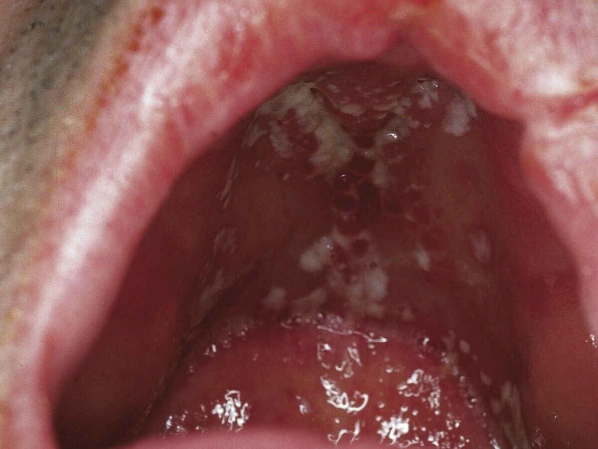 Oralverkehr mundsoor durch Mundsoor: Ursachen,