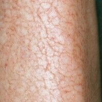 Exsikkationsdermatitis Images - Altmeyers Encyclopedia - Department ...