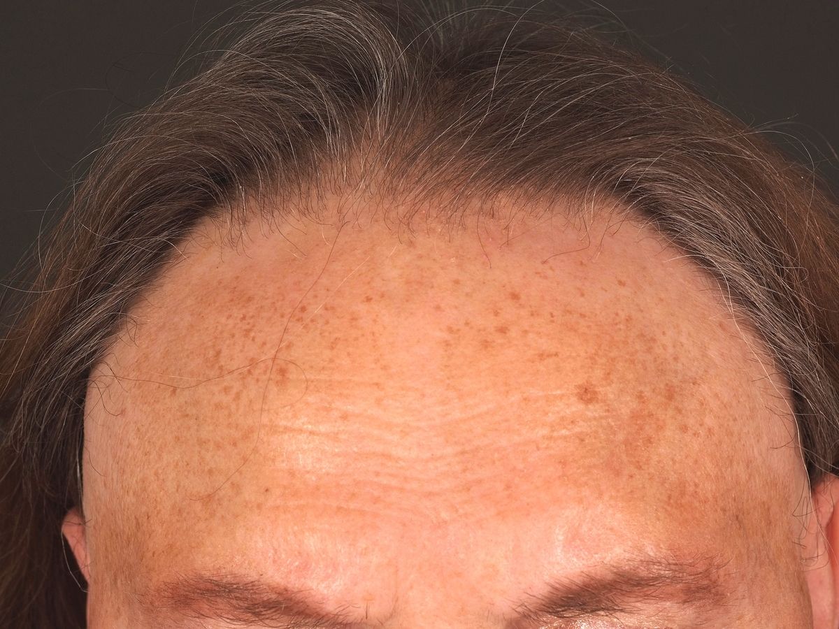 Frontal Fibrosierende Alopezie Altmeyers Enzyklopadie Fachbereich Dermatologie