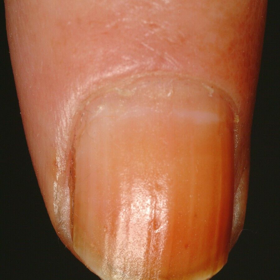 tobacco nails Nicotine nail - Altmeyers Encyclopedia