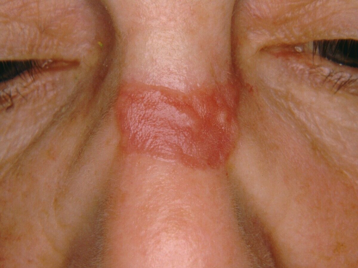 Vollhauttransplantation - Altmeyers Enzyklopdie - Fachbereich Dermatologie