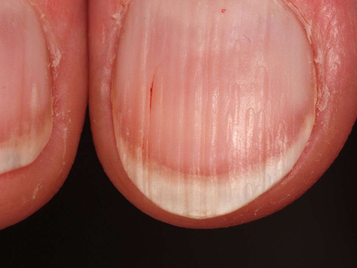 Splinter hemorrhages - Altmeyers Encyclopedia - Department Dermatology Splinter hemorrhages - Altmeyers Encyclopedia - Department Dermatology