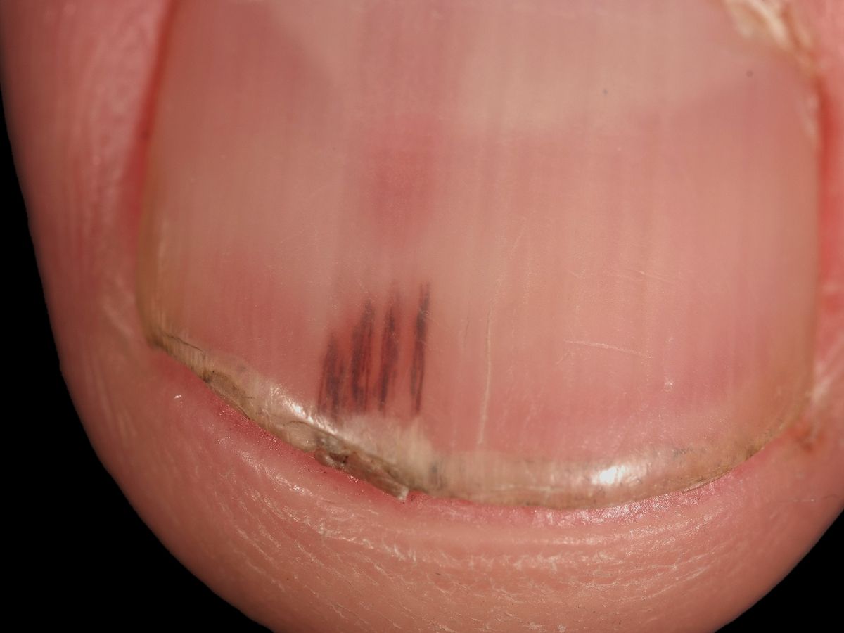 Splinter hemorrhages - Altmeyers Encyclopedia - Department Dermatology Splinter hemorrhages - Altmeyers Encyclopedia - Department Dermatology
