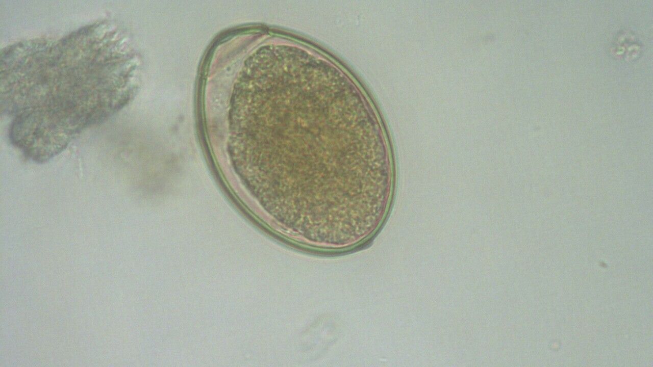 mi okozza a diphyllobothriasis