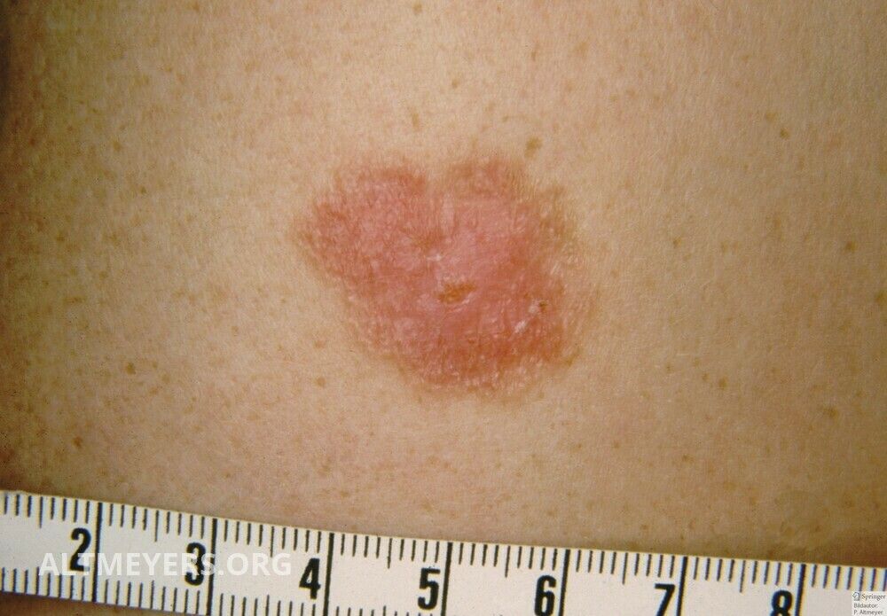 Swivel Flap Plastic Altmeyers Encyclopedia Department Dermatology