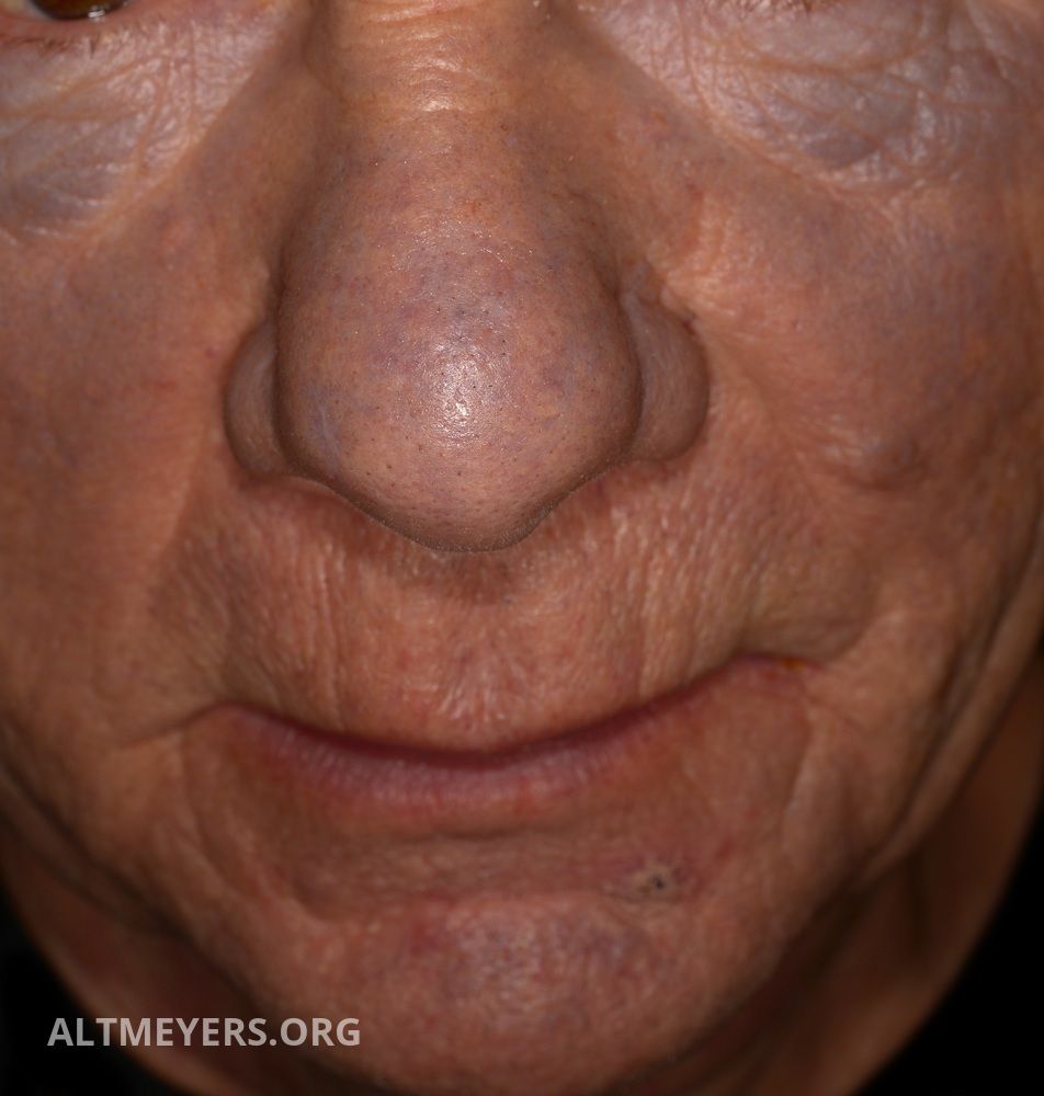 Skin Discoloration from Amiodarone