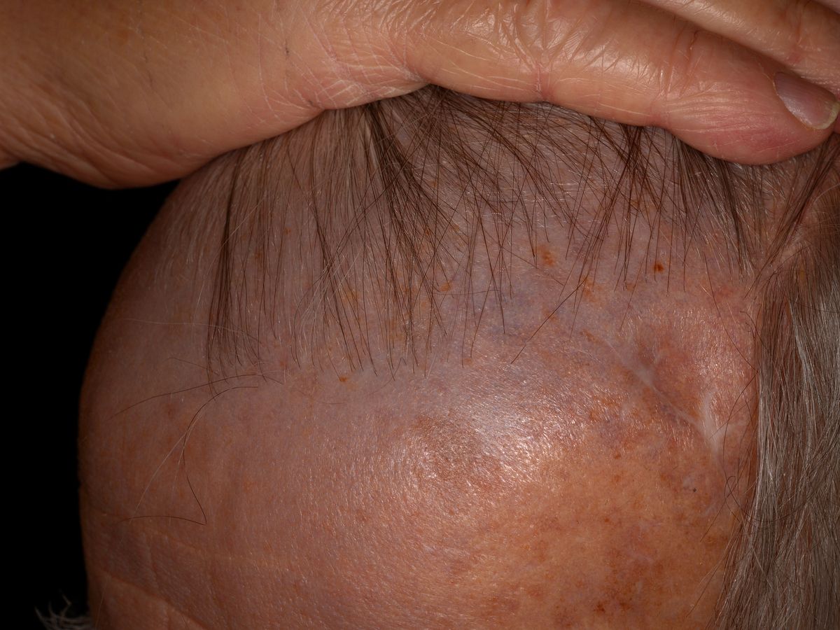 Skin Discoloration from Amiodarone