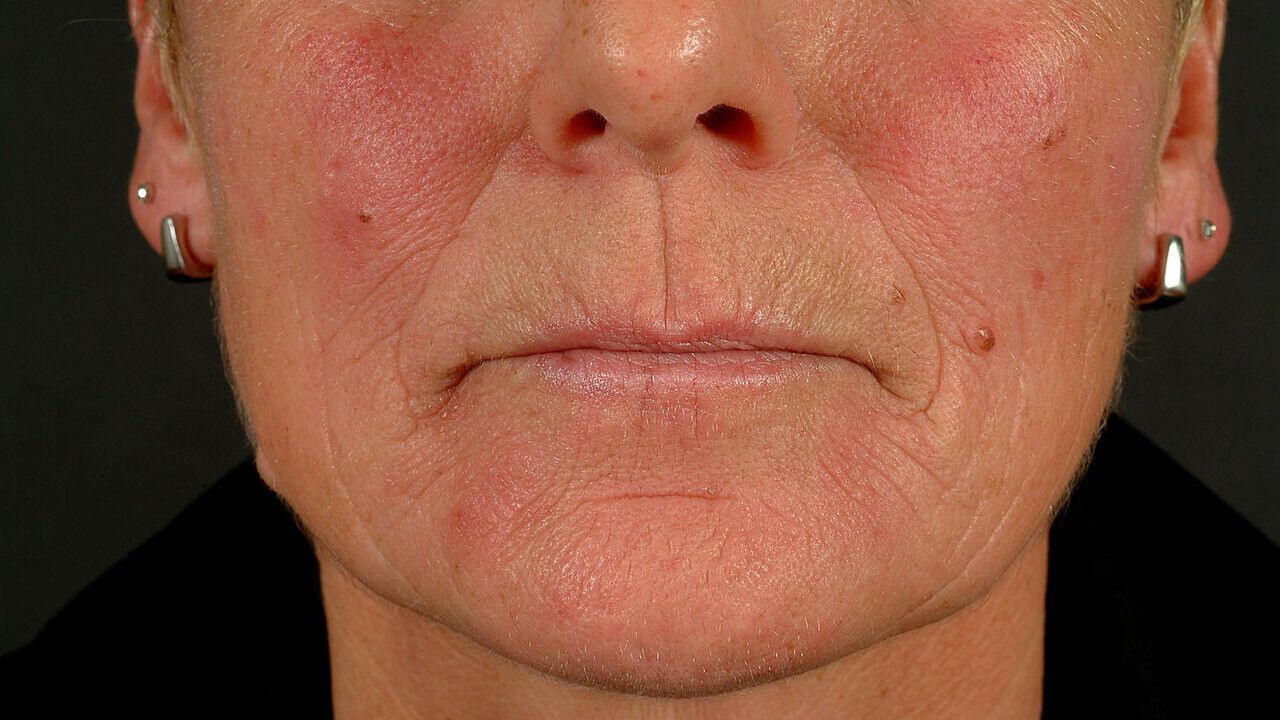 pics Alkoholiker Gesichtsrötung rosacea erythematosa altmeyers