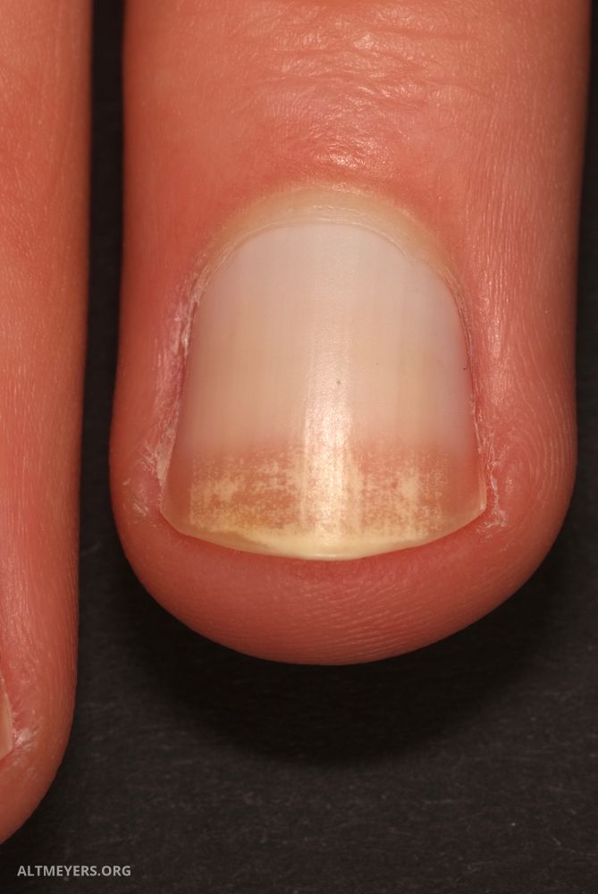 Half And Half Nails Altmeyers Encyclopedia Department Dermatology